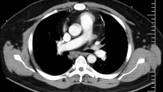 Mediastinal Anatomy on CT Discussion by a Radiologist [upl. by Manwell672]