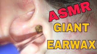 EAR WAX REMOVAL ASMR [upl. by Donough484]