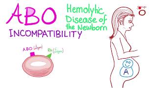 ABO Incompatibility  Hemolytic Disease Of The Newborn HDN  Hematology amp Pathology [upl. by Berny329]