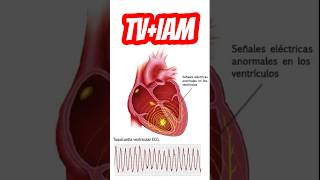 Cardioversión ⚡️en TV  SCA🫀 emergency uci [upl. by Thatcher849]