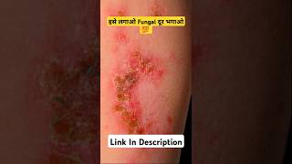 The Truth About Boric Acid For Fungal Treatment shorts medifact [upl. by Laehpar264]