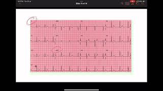 Quick Basic ECG شرح [upl. by Duyne]