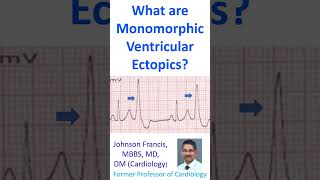 What are monomorphic ventricular ectopics [upl. by Fortunio]