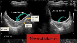 Normal Uterus and Ovaries  Ultrasound Case [upl. by Euqinahs]