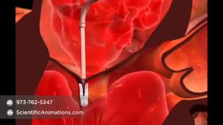 Mitral Valve Repair Surgery  Cardiac Animation [upl. by Nauqad]