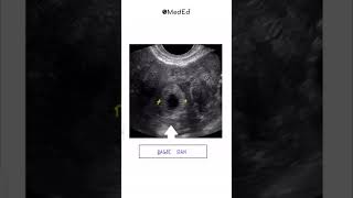 Essential Radiological Signs in OBGYN for NEET PG INICET and FMGE 📚 pwmeded [upl. by Toomay]