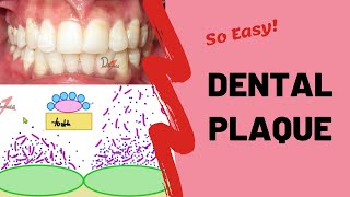 Dental Plaque  Types and Formation [upl. by Garris94]