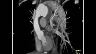 4D Imaging of the Aortic Valve Arch Pseudoaneurysm 8 of 8 [upl. by Rebmac466]