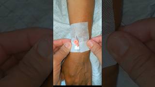 IV Cannulation subscribe cannula ivcannula health shortsindia [upl. by Southworth82]