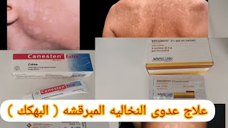 علاج البهك عدوى النخالية المبرقشة [upl. by Beshore]