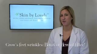 Botox or dermal filler for quotCrows feetquot wrinkles [upl. by Benzel]