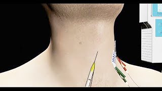 Spasmodic Dysphonia Treated with EMG Guided Botox Injection [upl. by Penhall595]