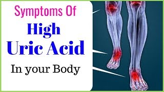 Signs and symptoms of high uric acid level in a body [upl. by Adehsar]