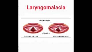 Laryngomalacia mrcpch Recall Communication [upl. by Joan]