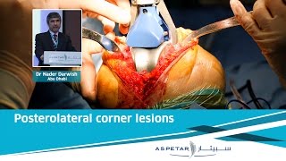 Posterolateral corner lesions  Dr Nader Darwich [upl. by Acissj]