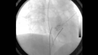 How to perform Transeptal Puncture [upl. by Eibrad]