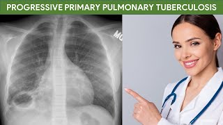 Progressive Primary Pulmonary Tuberculosis in Chest Xray amp CT Scan [upl. by Norri]