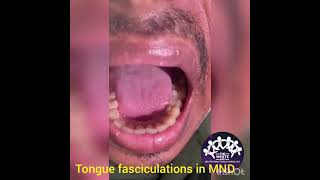 TONGUE FASCICULATIONS [upl. by Zere277]