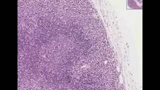 Histopathology Lymph nodeNodal marginal zone Bcell lympho [upl. by Deenya]