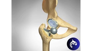 Quick View  Hip Replacement Hip Arthroplasty  3D Animation [upl. by Ettenaj]