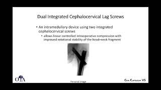 Intertrochanteric femur fractures  3 of 3 [upl. by Eelesor]