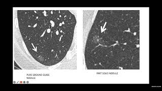 Day of Lung Science August virtual session [upl. by Lrac]