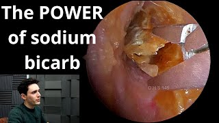 Sodium Bicarbonate Drops VS Earwax amp Dead Skin [upl. by Jourdain]