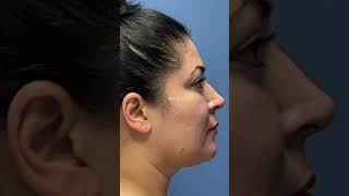 Natural Buccal Fat Removal [upl. by Ratib]