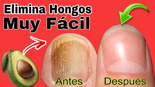 COMO Eliminar HONGOS de las UÑAS usando AGUACATE [upl. by Llesram31]