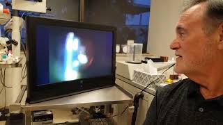 Eye Floater Treatment with Laser patient of Scott Geller MD [upl. by Bartholomeo]