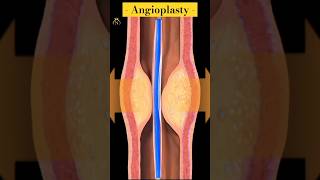 Angioplasty animation 3D shorts medical angioplasty [upl. by Fadiman]