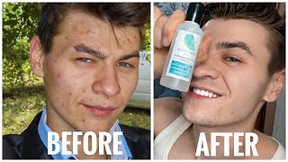 DIY CHEMICAL PEEL 20 BHA SALICYLIC ACID  BEST WAY TO GET RID OF ACNE SCARS AND BLACKHEADS [upl. by Ociral]