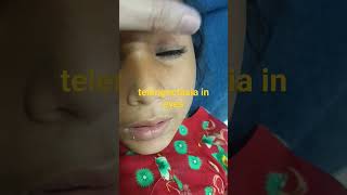 telangectasias in eyesataxia telangiectasiaclinical paeds [upl. by Namrej]