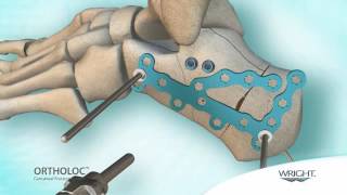 Wright  Ortholoc Calcaneal Fracture system [upl. by Mccready]