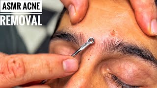 ASMR HEAD MASSAGE • Acne removal • Turkish Barber [upl. by Longley]