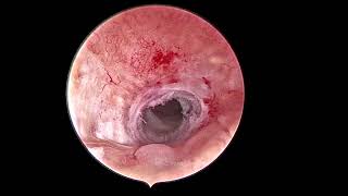 office procedure for external and internal os stenosis [upl. by Holton]