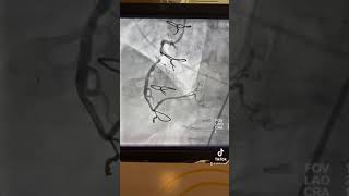 A Shockwave Lithotripsy C2 IVL Complex case of a tortuous RCA DrHamo [upl. by Shalna466]