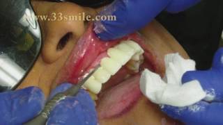 Dental Crowns and Bridges Procedure at Cosmetic Dental Associates in San Antonio TX [upl. by Durwyn]