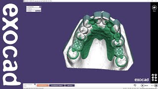 exocad Video Tutorial basic Designing a Removable Partial Framework [upl. by Frodeen]