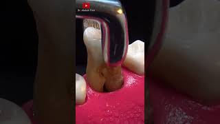 Extraccion dental en 4k shorts [upl. by Armilda186]