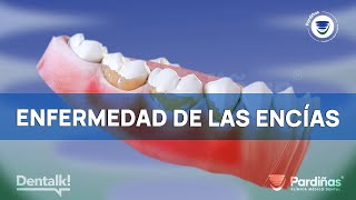 PERIODONTITIS  Esta ENFERMEDAD de las ENCÍAS es la principal causa de PÉRDIDA de DIENTES © [upl. by Xylia]