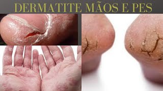 Como aliviar os sintomas da dermatite de contato com ervas medicinal [upl. by Nocam149]