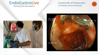 Hemostase endoscopique dun ulcère duodénal hémorragique [upl. by Remde]