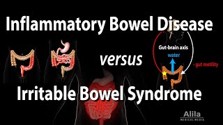 Inflammatory Bowel Disease vs Irritable Bowel Syndrome Animation [upl. by Anits803]