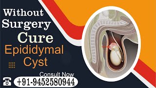 How do you get rid of an epididymal cyst naturally Know by Dr Nizamuddin Qasmi sir [upl. by Ramel]