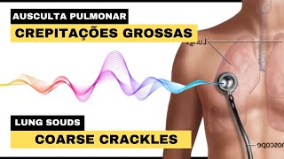 CREPITAÇÕES GROSSAS AUSCULTA PULMONAR  Crackles Coarse Lung Sounds [upl. by Stanislas793]