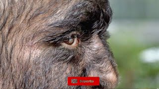 Hypertrichosis What is Werewolf Disease [upl. by Averat]