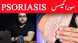 Dr ZeePsoriasis Treatment – The Best 3 Remedies for Psoriasis  सोरायसिस [upl. by Halullat]