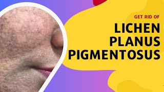 Get Rid of Lichen Planus Pigmentosus [upl. by Lally586]