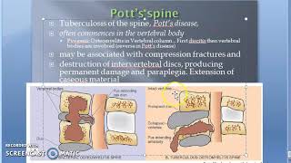 Pathology 825 h TB Spondylitis Tuberculous Osteomyelitis Potts Spine Disease disc body bone [upl. by Vetter979]